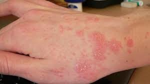 treatscabies