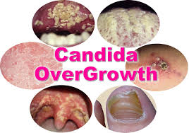 Treat Candidiasis Yeast And Thrush 