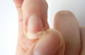 How To Treat Brittle Nails