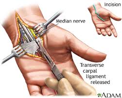 treating carpal tunnel