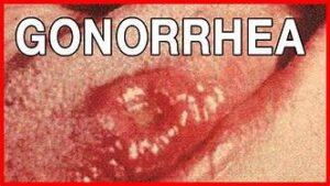 Sexual Intercourse Cause Gonorrhea